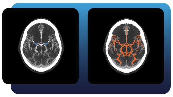 Imagen: Full Brain Solution identifica OVM y OVG además de aneurismas y hemorragias (Fotografía cortesía de Aidoc)