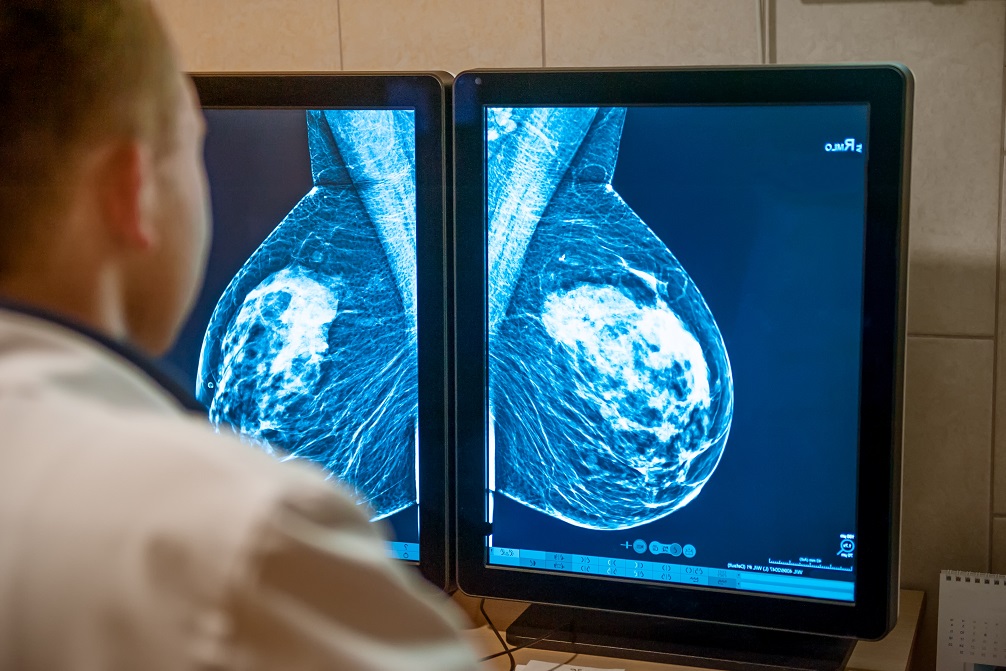 Imagen: El examen de mamografía respaldado por IA es seguro y reduce casi a la mitad la carga de trabajo del radiólogo (Fotografía cortesía de Shutterstock)