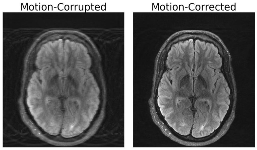 Imagen: Un modelo de aprendizaje profundo es capaz de corregir los movimientos en la resonancia magnética del cerebro (Fotografía cortesía del MIT)