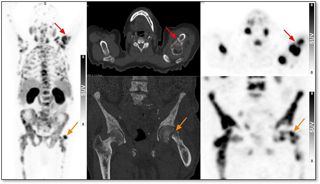 Imagen: PET/CT con 68GA-PSMA-11  del paciente masculino de 82 años con dolor óseo y niveles de APE de 960 ng/ml (Fotografía cortesía del Centro Médico Surasky de Tel Aviv )