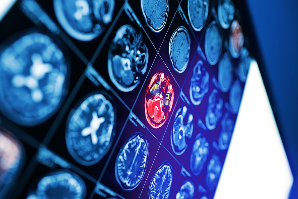 Imagen: La nueva tecnología de resonancia magnética evalúa la homeostasis de hierro normal y deteriorada en el cerebro (Fotografía cortesía de 123RF)