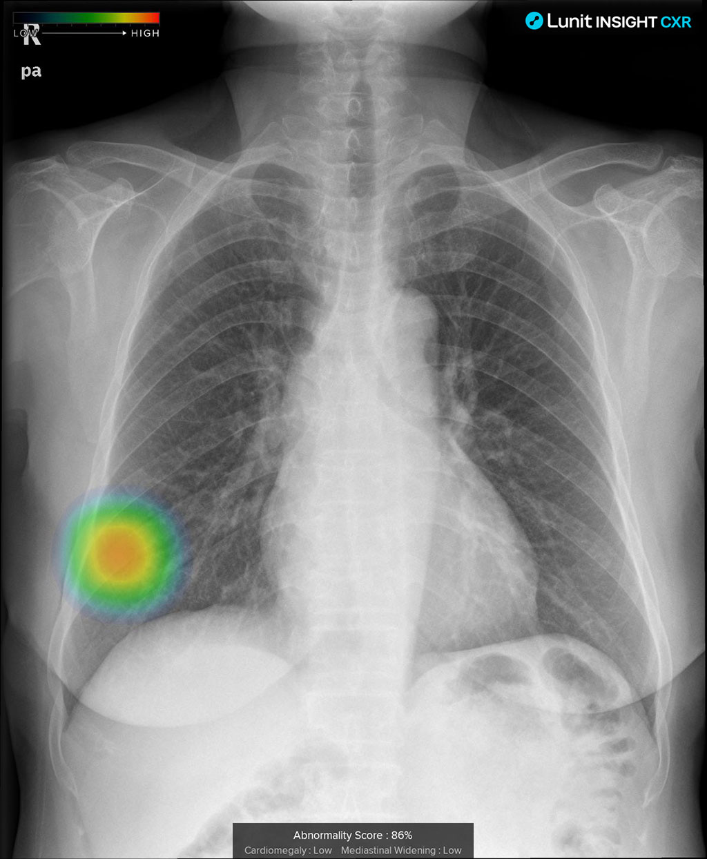 Imagen: El sistema de IA identifica el tubo endotraqueal colocado incorrectamente en las radiografías de tórax (Fotografía cortesía de Lunit)
