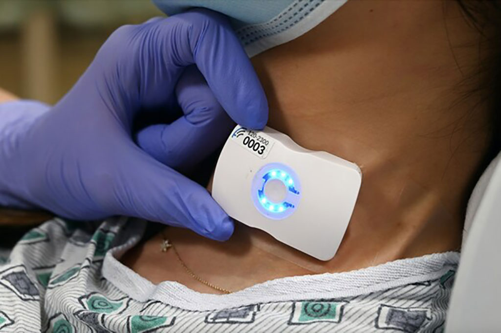 Imagen: FloPatch es una herramienta revolucionaria que facilita la precisión en tiempo real en el manejo de fluidos IV en la sepsis (Fotografía cortesía de Flosonics)