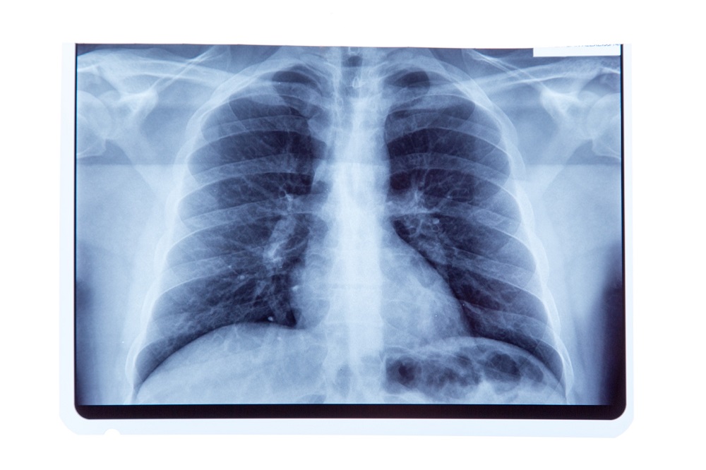 Imagen: La IA generativa puede ayudar en la interpretación de la radiografía de tórax en el departamento de emergencias (Fotografía cortesía de 123RF)