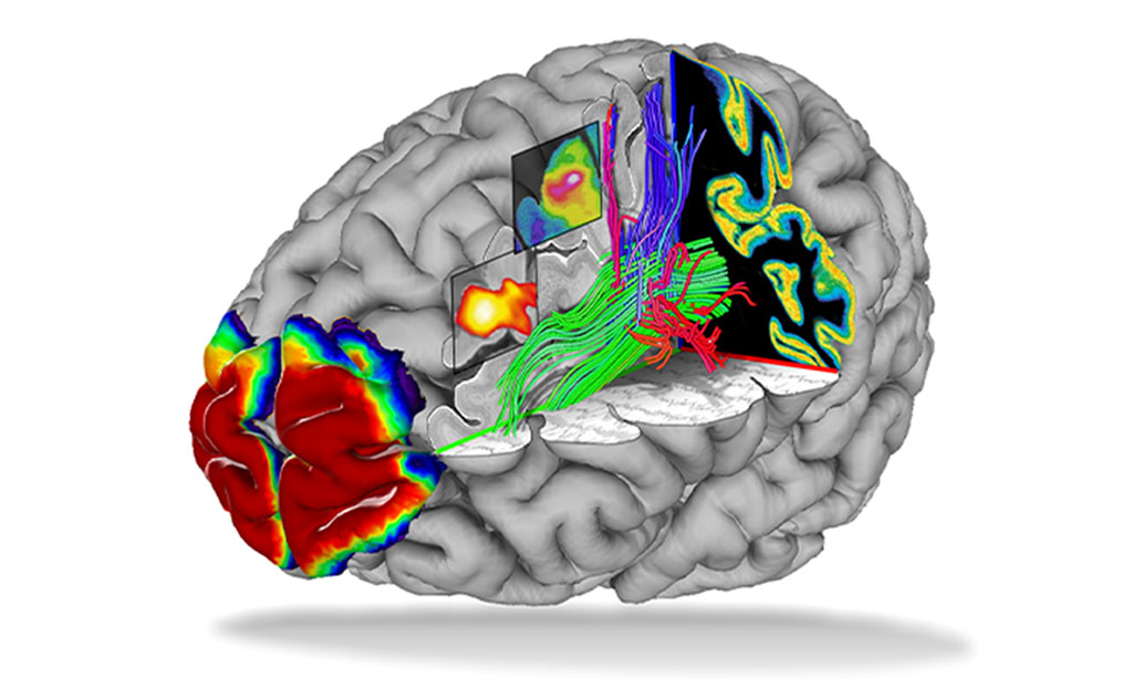 Imagen: La nueva herramienta de IA para imágenes PET permite una evaluación de alta calidad y totalmente automatizada de tumores cerebrales (Fotografía cortesía de INM)