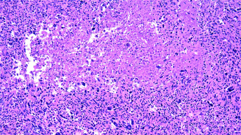 Imagen: Imagen histopatológica del leiomiosarcoma (Fotografía cortesía de ICR)