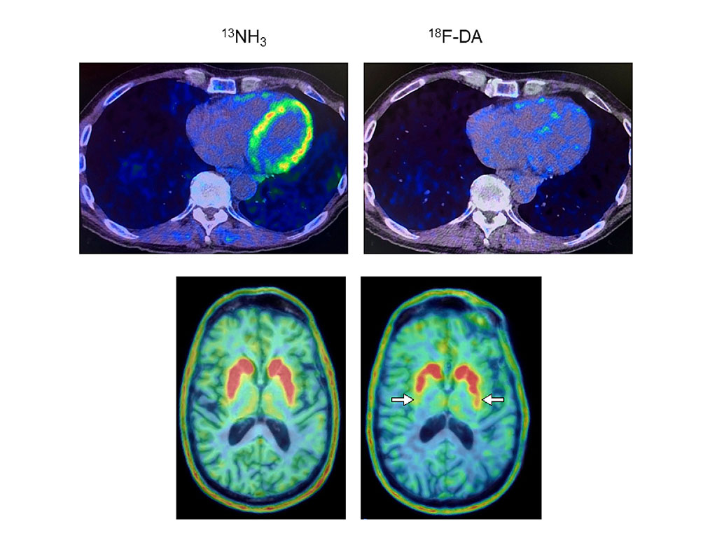 Imagen: Exploraciones PET de corazón y cerebro del participante del estudio que desarrollaron Parkinson  respalda la progresión del "cuerpo primero" (Fotografía cortesía de NIH)