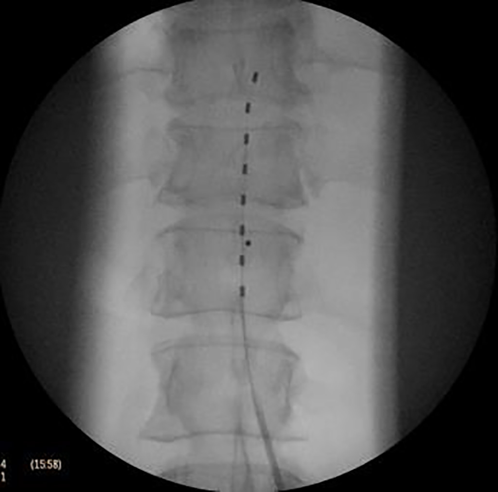 Imagen: Los EME implican la administración de señales eléctricas cerca de la médula espinal para reducir y controlar el dolor (Fotografía cortesía de PDIC)