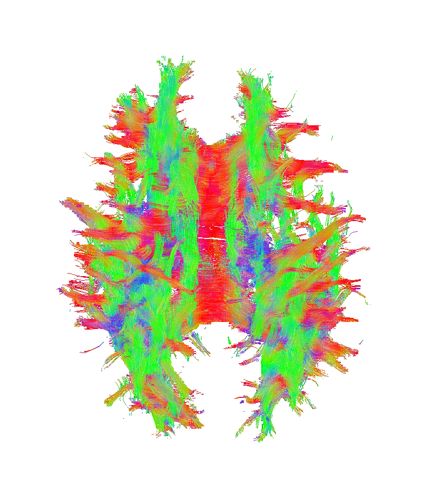 Imagen: Un nuevo algoritmo llamado DeepSTI toma datos de múltiples escaneos individuales y proporciona una 'súper exploración' del cerebro (Fotografía cortesía de la Universidad Johns Hopkins)