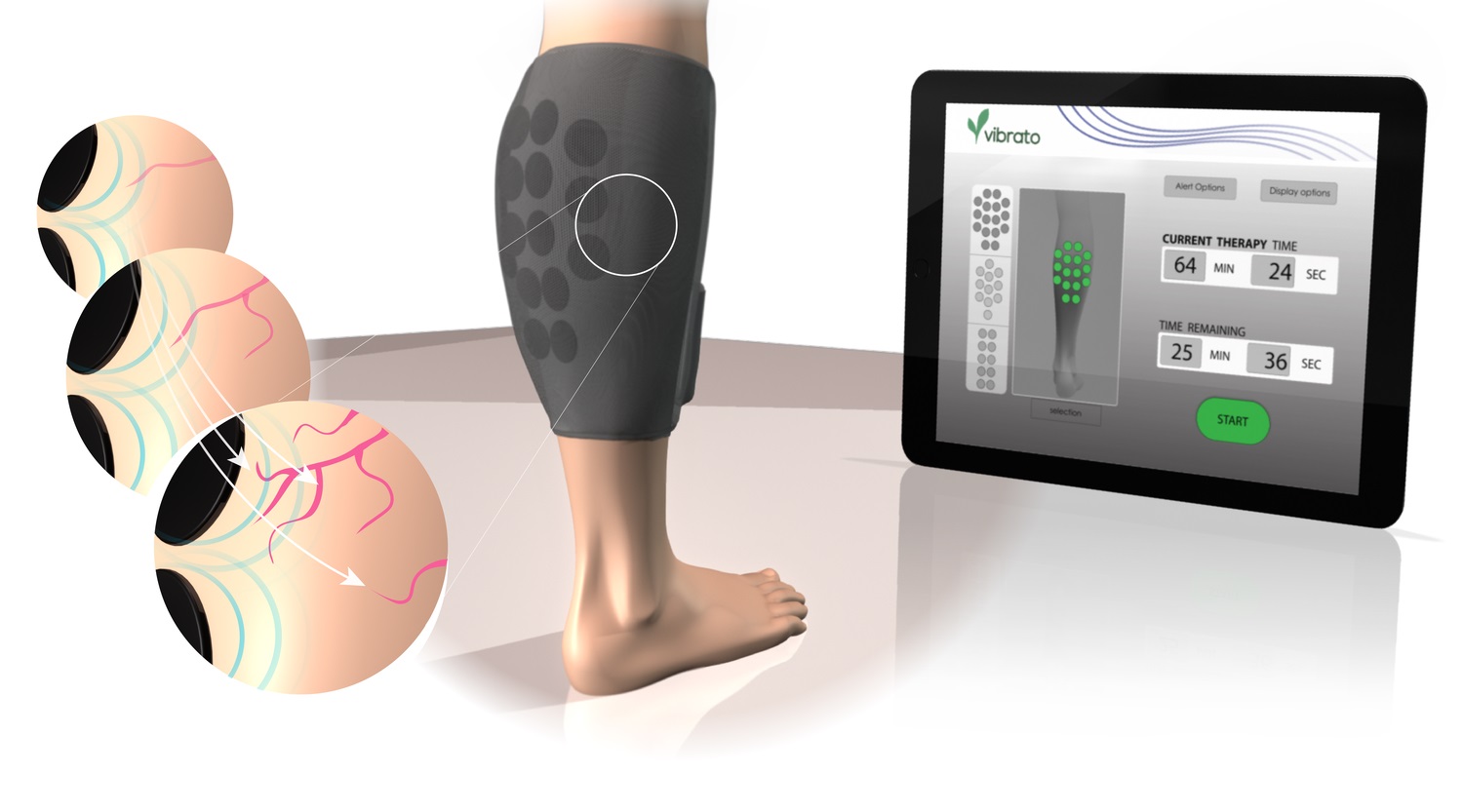 Imagen: La tecnología es el primer ultrasonido terapéutico portátil diseñado para promover la vasodilatación y el crecimiento de los vasos (Fotografía cortesía de Vibrato Medical)
