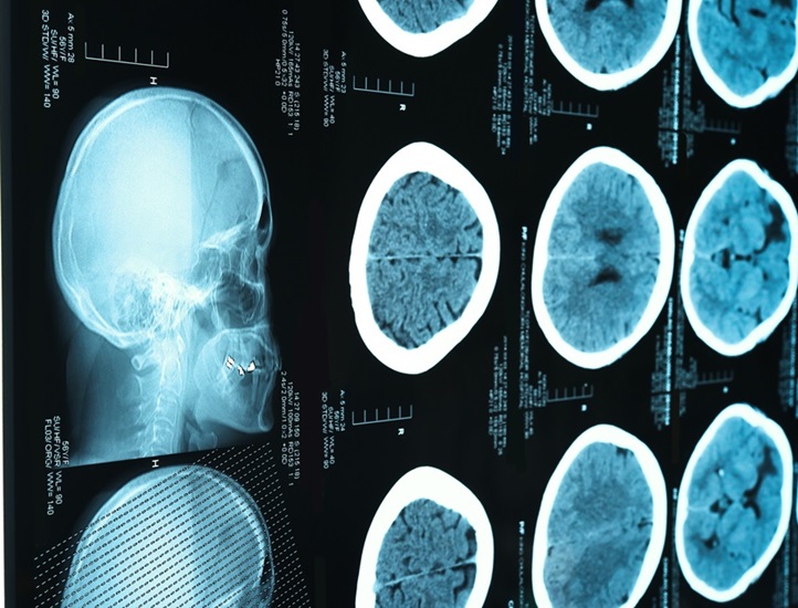 Imagen: Las exploraciones PET/CT tienen potencial para predecir la metástasis cerebral en pacientes con melanoma (Fotografía cortesía de 123RF)