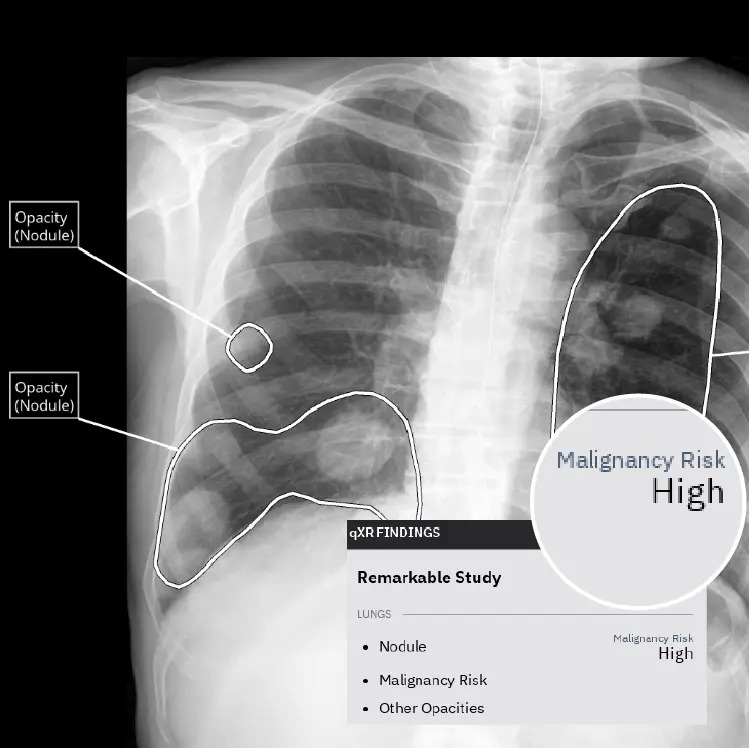 Imagen: El qXR-LN usa IA para identificar y localizar nódulos pulmonares (Fotografía cortesía de Qure.ai)