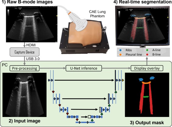Imagen: Diagrama de flujo de trabajo que muestra la segmentación de ultrasonido pulmonar en tiempo real con U-Net (Fotografía cortesía de Ultrasonics)
