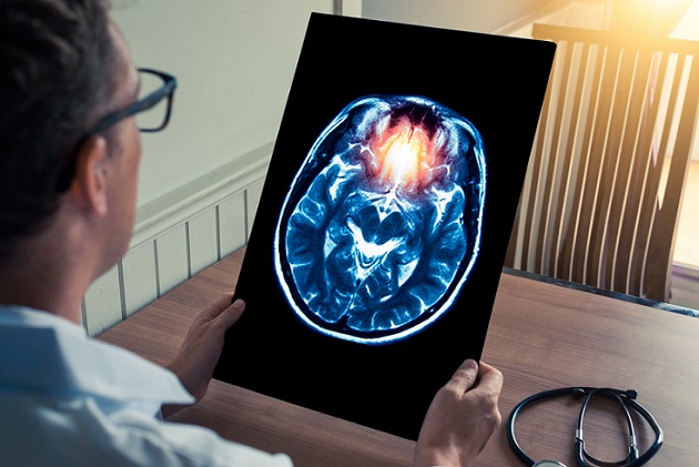 Imagen: Los investigadores están desarrollando mejores herramientas de diagnóstico y agentes de imágenes para detectar Alzheimer en etapa temprana (Fotografía cortesía de 123RF)