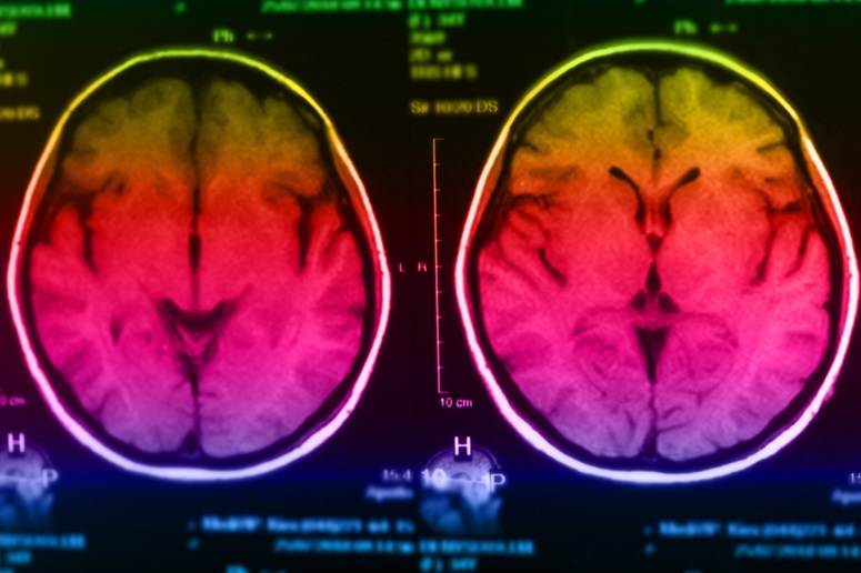 Imagen: Los investigadores han creado una nueva herramienta de extracción de resonancia magnética cerebral para neonatos (Fotografía cortesía de 123RF)