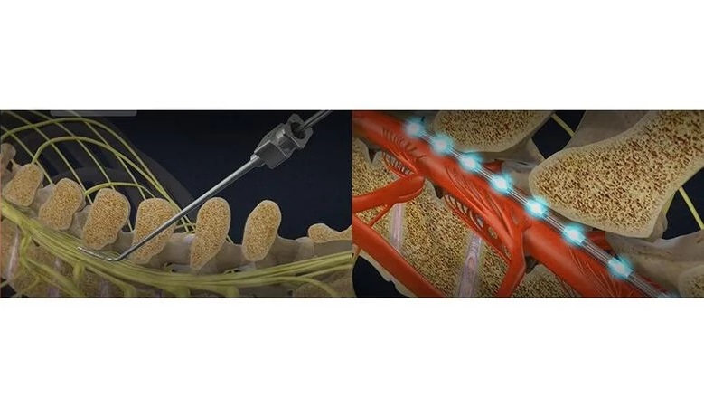 Imagen: Los médicos ahora pueden ver la actividad de la médula espinal durante la cirugía (Fotografía cortesía de UC Riverside)