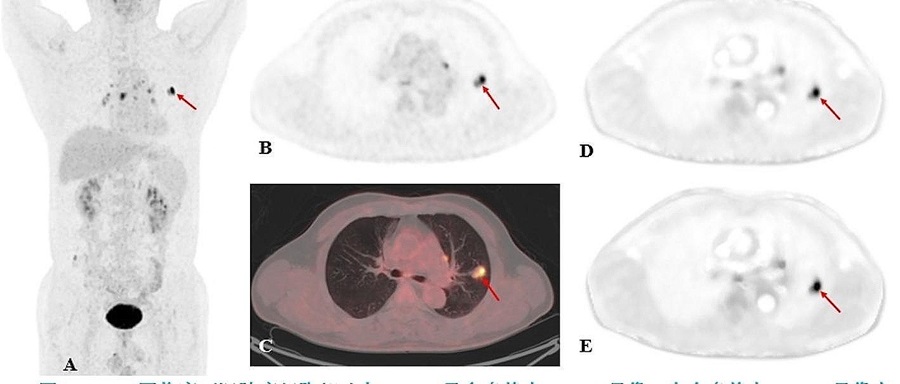 Imagen: PET/CT de un paciente masculino de 60 años con sospecha clínica de cáncer de pulmón (Fotografía cortesía de  EJNMMI Physics)