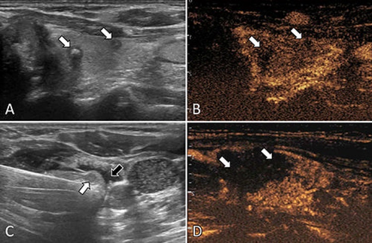 Imagen: El estudio comparó la ablación por microondas y la resección quirúrgica para el carcinoma papilar de tiroides multifocal (foto cortesía de RSNA)