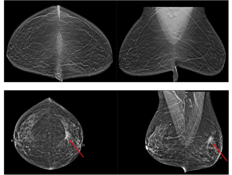 Imagen: La detección de cáncer de seno asistido por AI puede reducir las pruebas innecesarias (foto cortesía de Wustl)