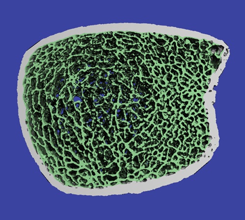 Imagen: La imagen HR-PQCT muestra la microarquitectura del hueso trabecular (en verde) y el hueso cortical (en blanco) dentro de la tibia distal (foto cortesía de la Universidad de Wake Forest)