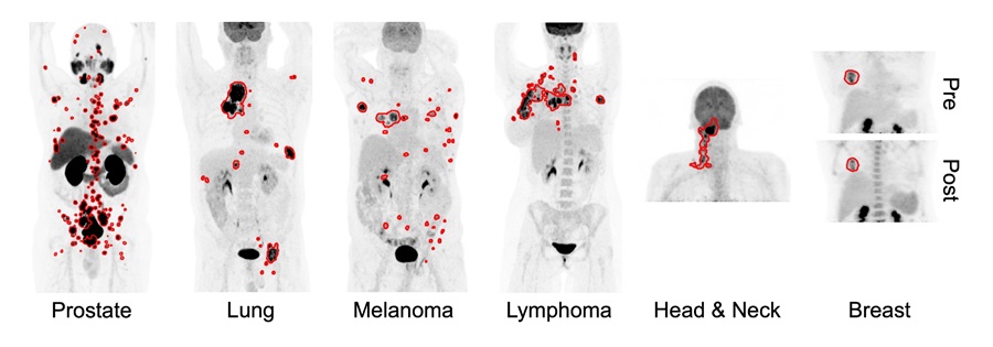 Imagen: Ejemplos ilustrativos de segmentaciones tumorales predichas mediante un enfoque de aprendizaje de transferencia profunda en seis tipos de cáncer (foto cortesía de la Universidad Johns Hopkins)