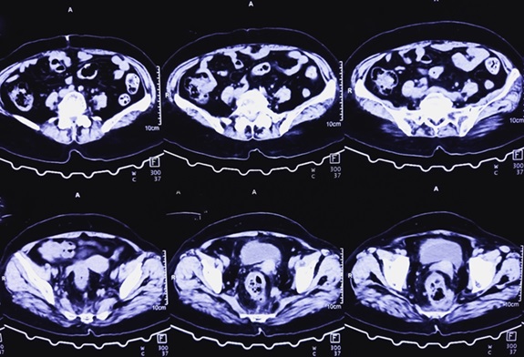 Imagen: Los investigadores utilizarán IA para derivar métricas específicas de las resonancia magnéticas y analizar de manera más efectiva la respuesta terapéutica de los tumores rectales (foto cortesía de Shutterstock)