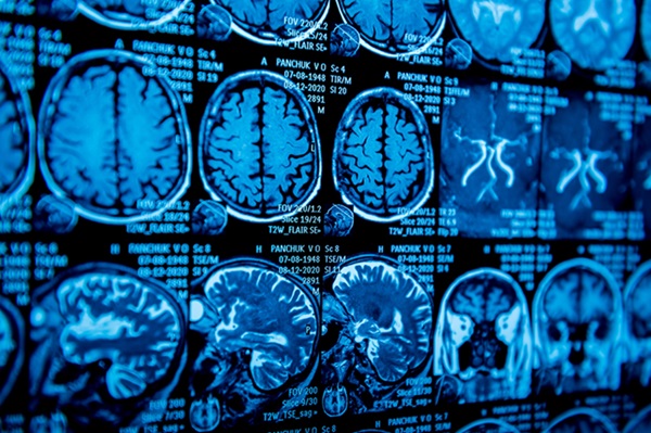 Imagen: Los resultados del estudio señalan un papel para la resonancia magnética en los ensayos de intervención para prevenir o retrasar la progresión de la enfermedad de Parkinson (foto cortesía de 123RF)