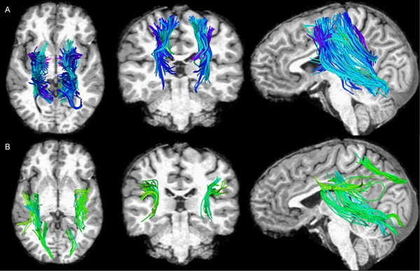 Imagen: Las vías del cerebro destacadas son las más afectadas por una conmoción cerebral (foto cortesía de Benjamin Hacker, et al)