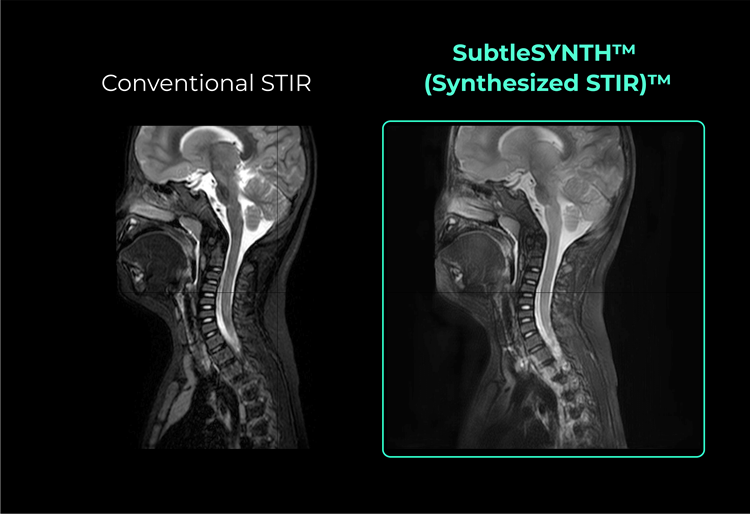 Imagen:  SubtleSYNTH crea imágenes STIR sintéticas que son intercambiables con las imágenes STIR adquiridas de manera convencional (foto cortesía de Subtle Medical)