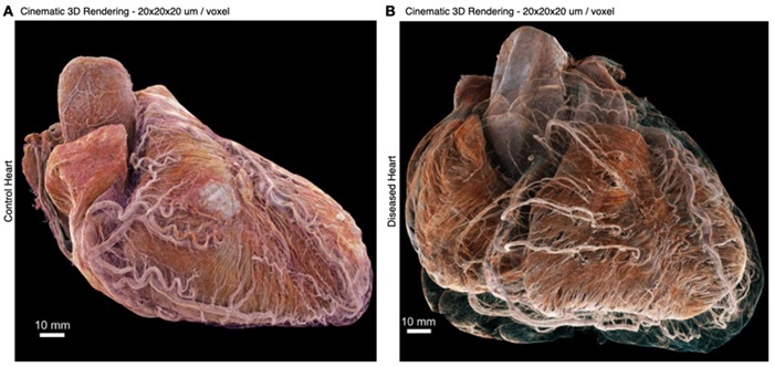 Imagen: Representaciones en 3D del corazón de control y del corazón enfermo en orientación anatómica (foto cortesía de ESRF)