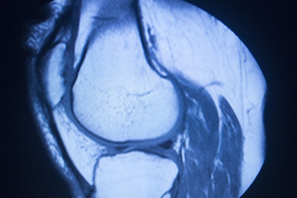 Imagen: El nuevo sistema de puntuación de RM puede evaluar la malignidad ósea en pacientes con sarcoma de tejidos blandos después de la radioterapia (foto cortesía de 123RF)