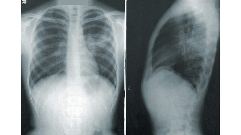 Imagen: El ultrasonido cuantitativo de pulmón  puede utilizarse para estadificar y controlar las enfermedades pulmonares intersticiales  (foto cortesía de los CDC)