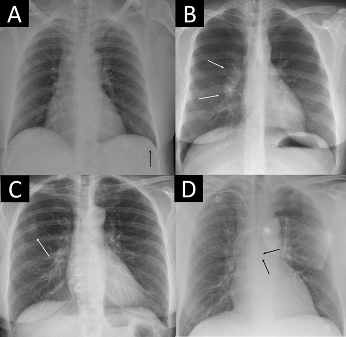 Imagen: Cuatro ejemplos de radiografías de tórax notables con hallazgos críticos pasados por alto (Foto cortesía de Radiología; https://doi.org/10.1148/radiol.240272)