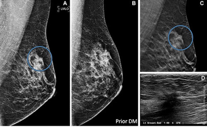 Imagen: La TDM ayudó a aumentar la tasa de detección del cáncer de mama y detectó cánceres invasivos con una tasa más baja de cánceres avanzados en comparación con la MD (Foto cortesía de Radiology; doi.org/10.1148/radiol.232841)