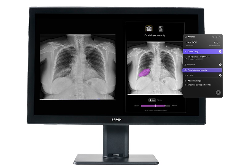 Imagen: El Annalise Enterprise CXR  puede detectar hasta 124 hallazgos en radiografías de tórax en segundos (foto cortesía de Annalise.ai)