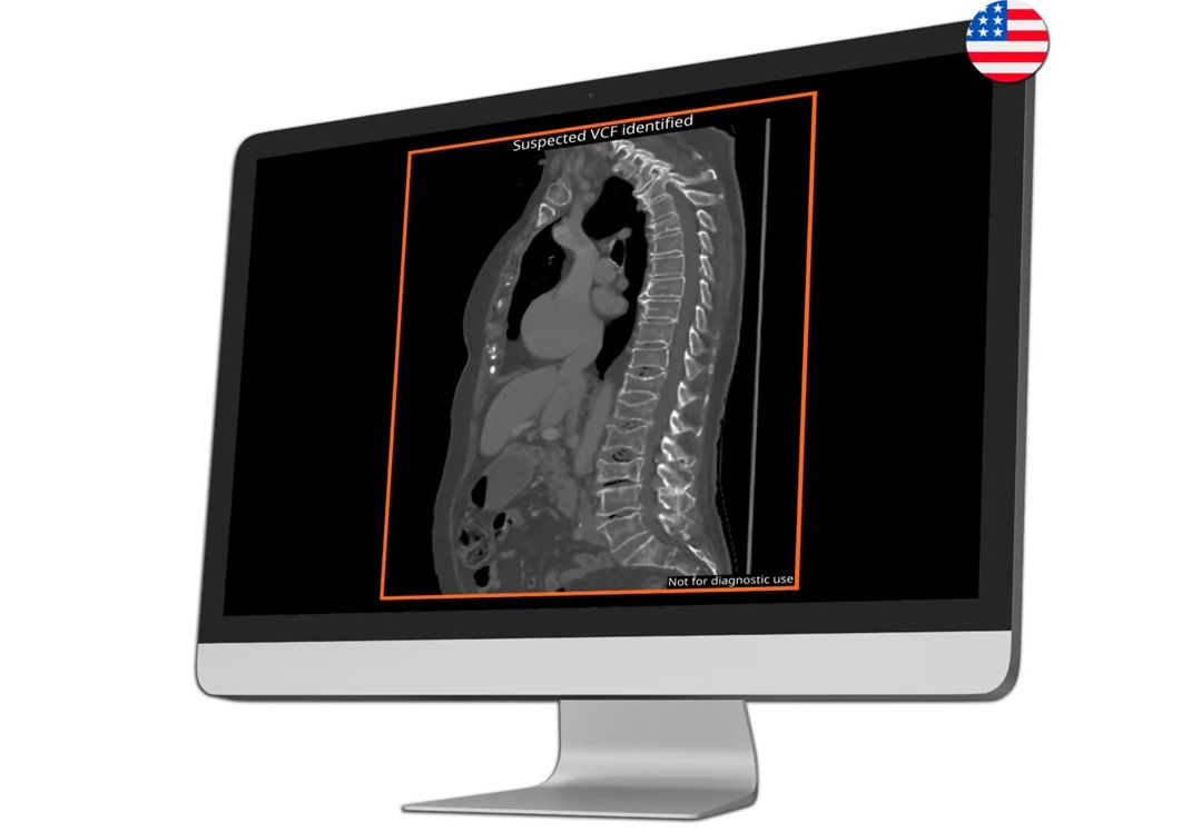 Imagen: El algoritmo CINA-C Spine permite la detección y clasificación de fracturas de la columna cervical (foto cortesía de Avicenna.AI)