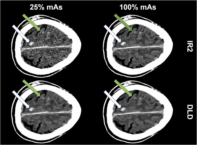 Imagen: Comparación de la reconstrucción iterativa (IR2) y la eliminación de ruido basada en aprendizaje profundo (DLD) al 100% mAs y 25% mAs en una TC cerebral sin contraste en un paciente con una lesión cerebral traumática (foto cortesía de Academic Radiology; doi.org/10.1016/j.acra.2024.08.018)