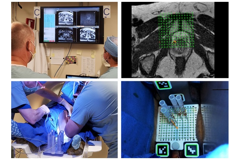 Imagen: El sistema de navegación de realidad aumentada podría mejorar la precisión de la punción lumbar (foto cortesía de Clear Guide Medical)