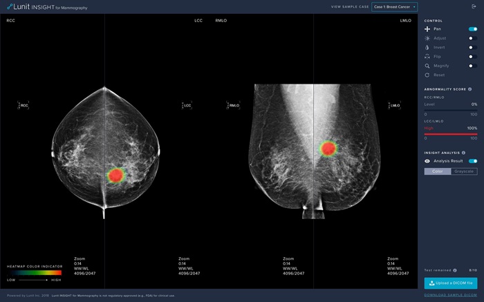 Imagen: El software INSIGHT MMG detecta el cáncer de mama con una precisión del 97% (Photo cortesía de Lunit Inc.)