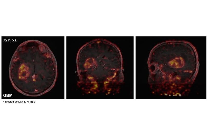 Imagen Escaneos PET del cerebro de un paciente con glioblastoma, 72 horas después de la inyección del radiotrazador (Foto cortesía del Dr. Gabriela Kramer-Marek, Instituto de Investigación del Cáncer, Londres)