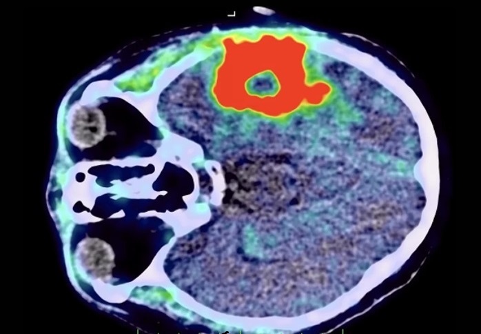 Imagen:El agente de imágenes PET Pixclara para gliomas podría brindar a los pacientes una mayor claridad diagnóstica (foto cortesía de Telix)