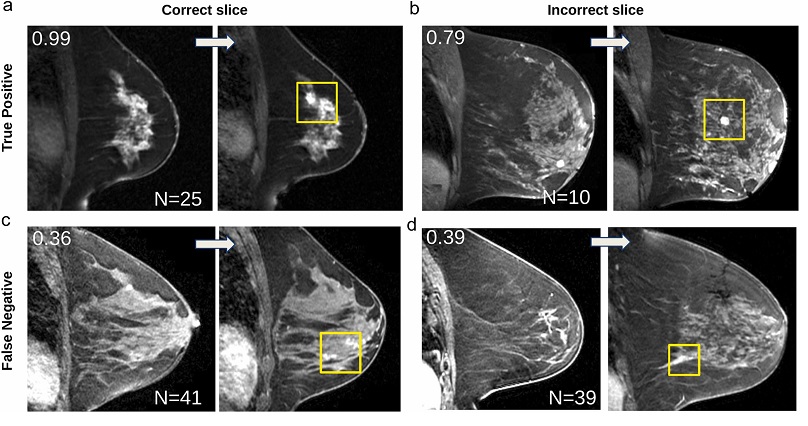 Imagen: Cada uno de los cuatro paneles muestra el seno sano en la resonancia magnética actual (izquierda) y el cáncer en la RM posterior (derecha), con el cáncer destacado en amarillo (foto cortesía de Academic Radiology; doi.org/10.1016/j. ACRA.2024.10.014)