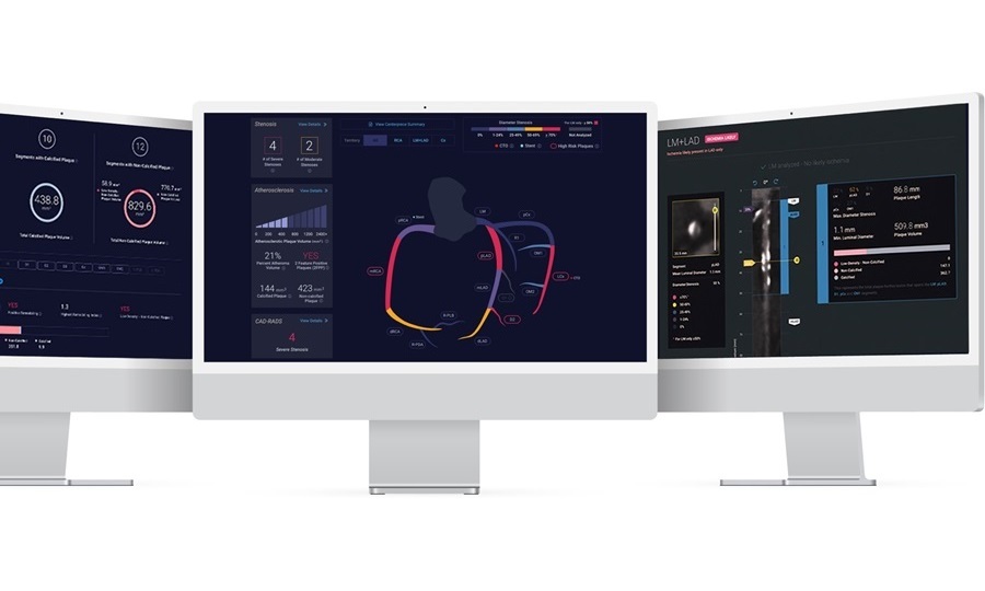 Imagen: Cleerly ofrece una solución CCTA habilitada para AI para una evaluación personalizada, precisa y medible de placa, estenosis e isquemia (foto cortesía de Cleerly)