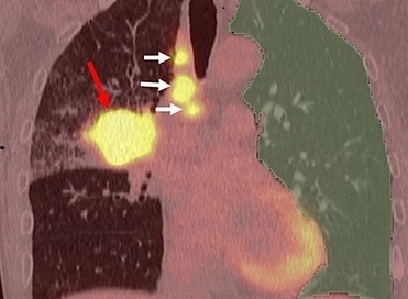 Imagen: Ejemplo de análisis de IA de imágenes PET/TC (foto cortesía de Academic Radiology; DOI: 10.1016/j.acra.2024.08.043)