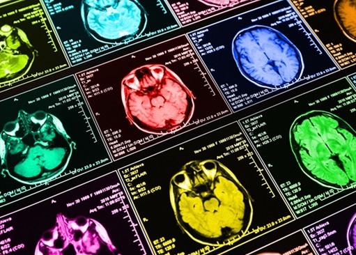 Imagen: Los modelos de inteligencia artificial pueden entrenarse para distinguir los tumores cerebrales del tejido sano (foto cortesía de 123RF)