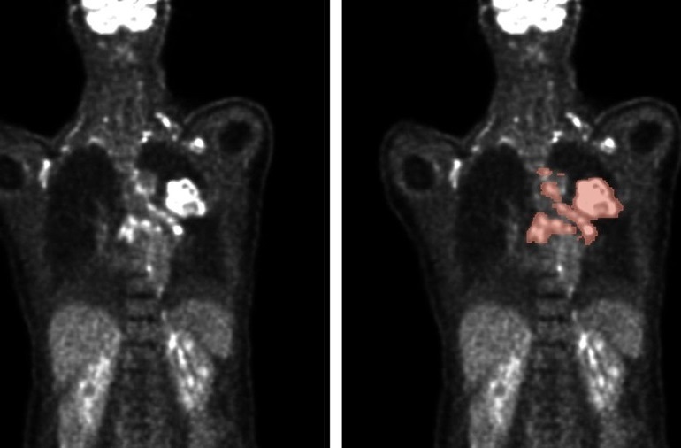 Imagen: Los métodos automatizados permiten el análisis de exploraciones PET/TC (izquierda) para predecir con precisión la ubicación y el tamaño del tumor (derecha) (Foto cortesía de Gatidis S, Kuestner T, Nature Machine Intelligence, 2024. DOI: 10.1038/S42256-024-00912 -9)