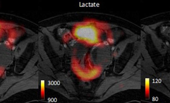 Imagen: La técnica de imágenes basada en RM permite una evaluación rápida de los subtipos de cáncer de ovario y su respuesta al tratamiento (foto cortesía de la Universidad de Cambridge)