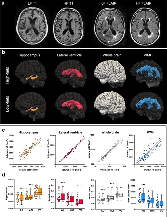 Imagen: Aplicación de LF-SynthSR v2 y WMH-SynthSeg a una cohorte de sujetos con deterioro cognitivo leve (DCL)/enfermedad de Alzheimer (EA) que fueron sometidos a imágenes en la clínica de LF (Foto cortesía de Nature Communications; doi.org/10.7910/dvn/9panmc)