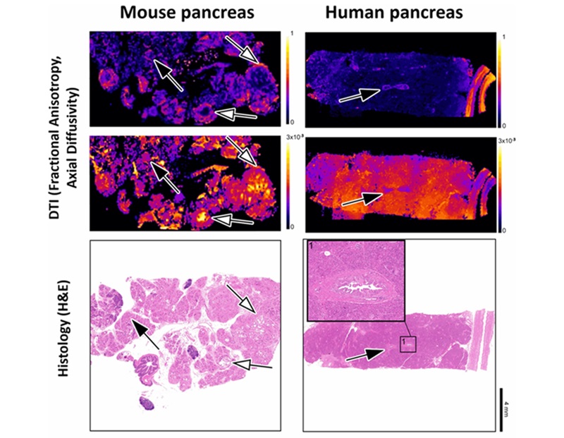 Imagen: Microscopía de resonancia magnética del páncreas de ratón y humano con histología respectiva que demuestra la capacidad de los mapas ITD para identificar lesiones premalignas (foto cortesía de Bilreiro C, et al. Investigative Radiology, 2024)