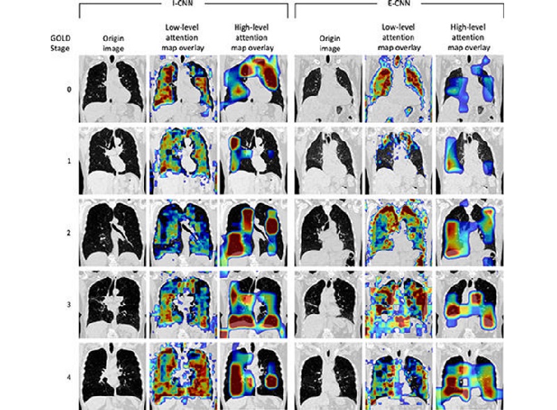 Imagen: Los mapas de atención de bajo y alto nivel para individuos en cada etapa GOLD para las CNN I y E (Foto cortesía de Radiology: Cardiothoracic Imaging, doi.org/10.1148/ryct.240005)